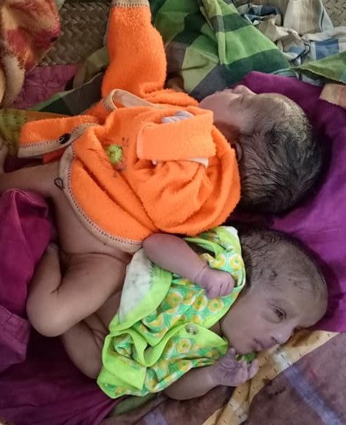 নাটোরে জোড়া লাগানো জমজ শিশুর জন্ম