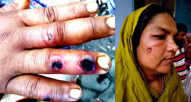 লালপুরে ৯ জনের শরীরে অ্যানথ্রাক্স রোগের সংক্রমন